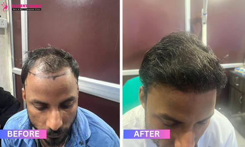 best hair transplant result in patna